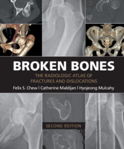 Broken Bones - The Radiologic Atlas 2nd Edition by Felix S. Chew