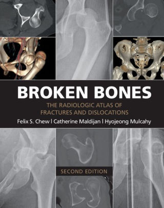 Broken Bones - The Radiologic Atlas 2nd Edition by Felix S. Chew