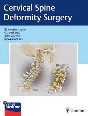 Cervical Spine Deformity Surgery by Christopher Ames