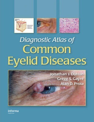 Diagnostic Atlas of Common Eyelid Diseases By Jonathan J. Dutton