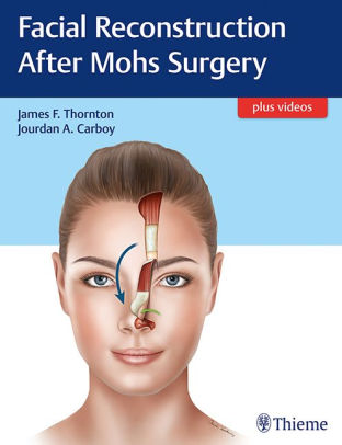 Facial Reconstruction After Mohs Surgery by James Thornton