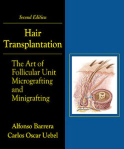 Hair Transplantation 2nd Edition by Alfonso Barrera
